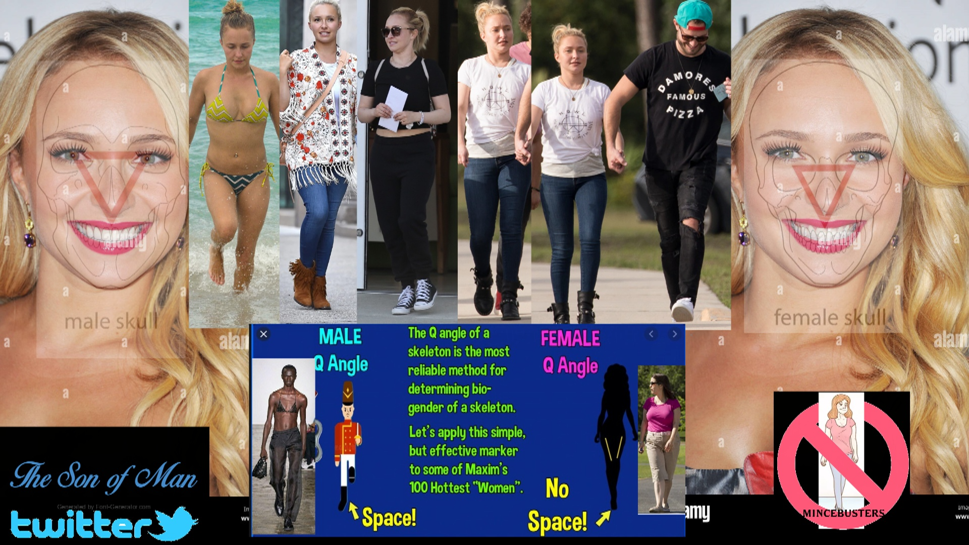 A collage of a peron walking with commentary about the Q Angle of a skeleton.